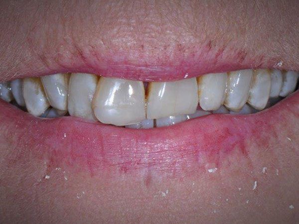 Damaged and discolored smile before cosmetic dentistry