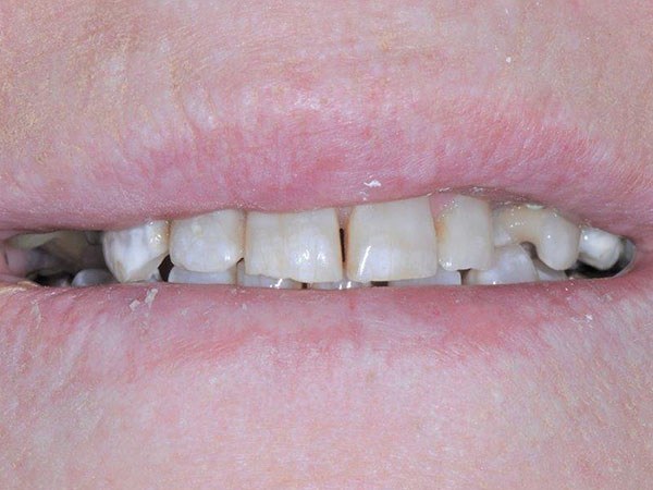 Worn and yellowed teeth before cosmetic dentistry