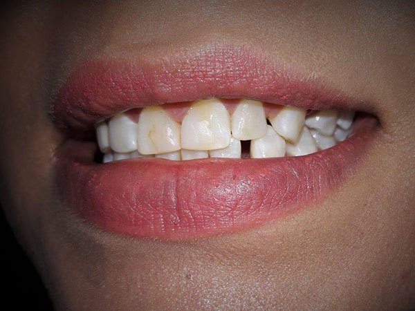 Yellow and unevenly spaced teeth before treatment