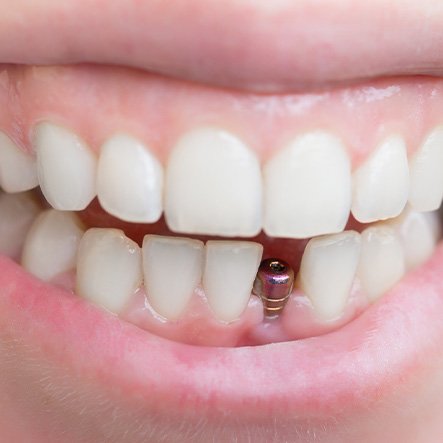 Closeup of someone’s smile with dental implant post in lower arch