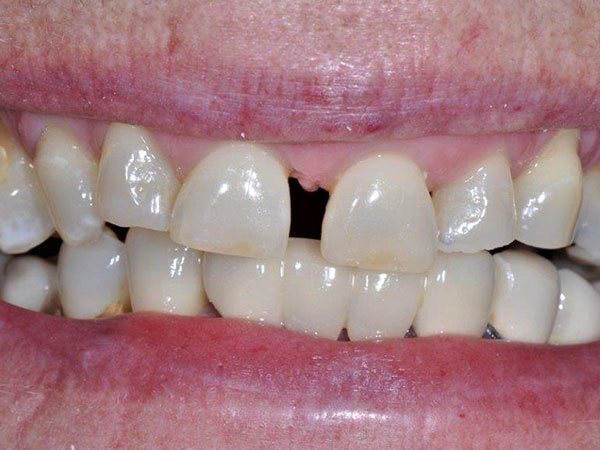 Smile with large gap between top front teeth