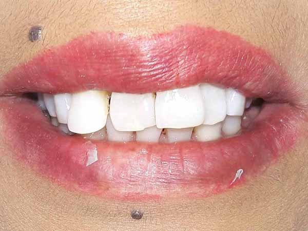 Chipped and overlapping top teeth