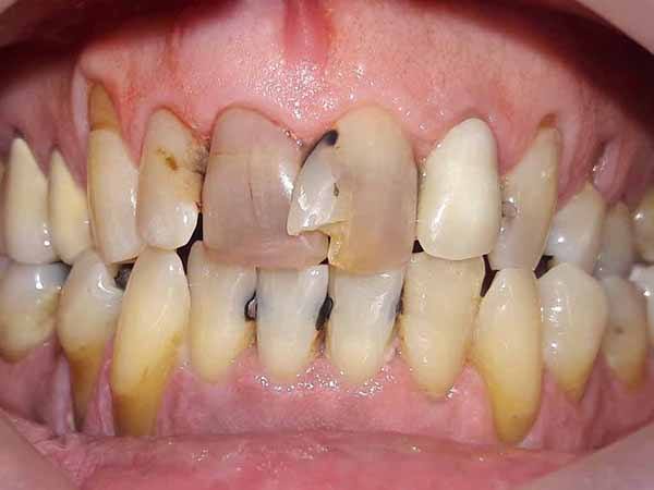 Severe and extensive tooth decay and damge