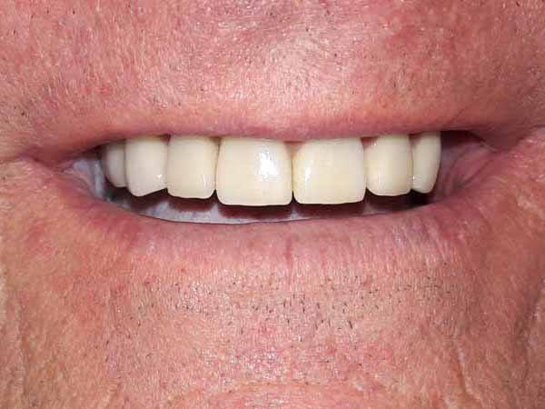 Smile restored with natural looking dental restorations