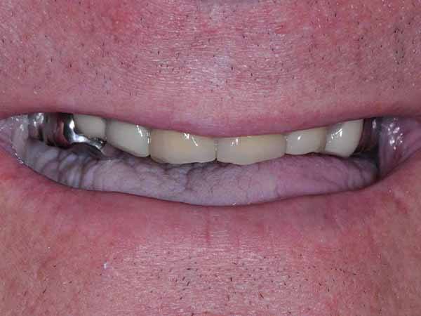 Smile with worn teeth and dark colored dental crowns