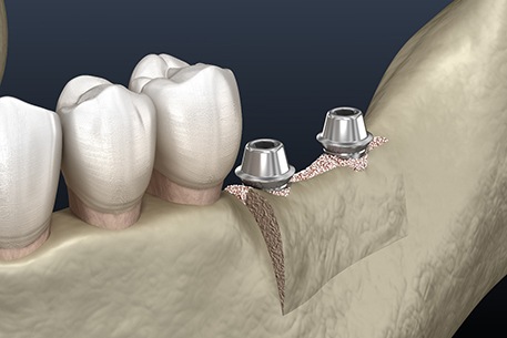 Illustration of dental implants in bone at site of ridge expansion surgery