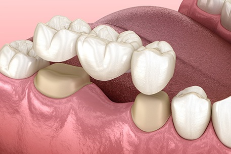 A 3D illustration of a dental bridge