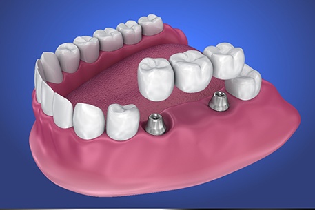 A 3D illustration of an implant dental bridge 