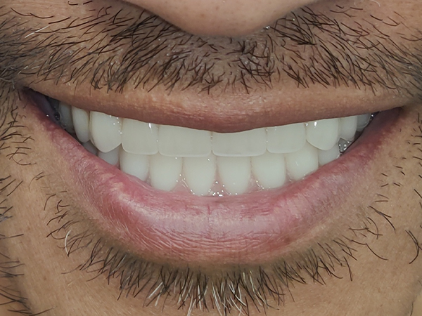 Flawlessly repaired and aligned smile