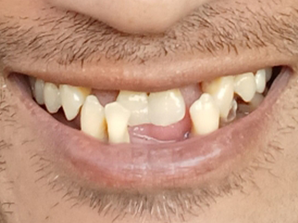 Chipped and overlapping top teeth
