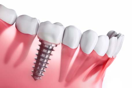 Digital illustration showing dental implants in Cottonwood Heights