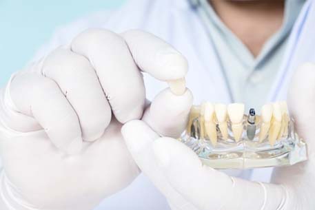 Cottonwood Heights implant dentist holding model dental implant and jaw