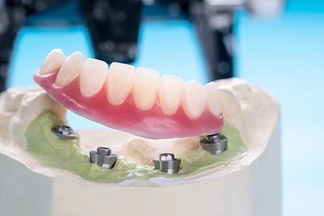 dentures sitting on top of dental implants that are placed in a model of a mouth
