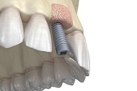 Digital illustration of bone graft for dental implant in Cottonwood Heights