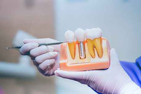 Dentist pointing to parts of dental implant in Cottonwood Heights