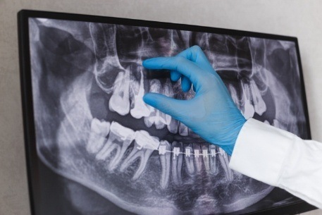 Dentist looking at x-ray of tooth in need of a root canal