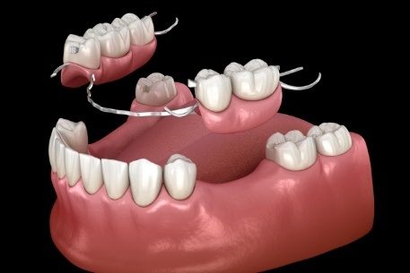 Animated smile during cast framework partial denture placement