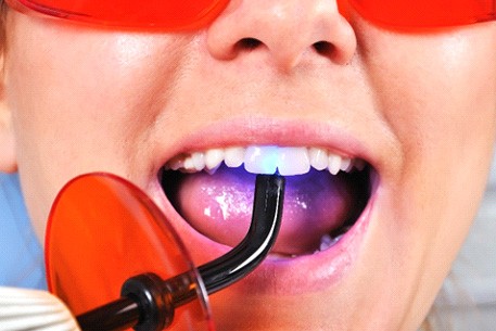 A male patient receiving tooth-colored fillings
