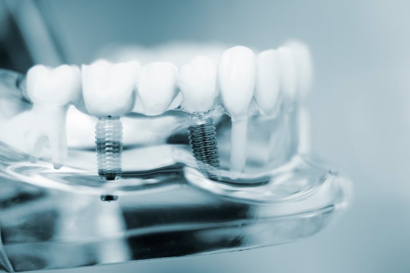 A close-up of dental implants