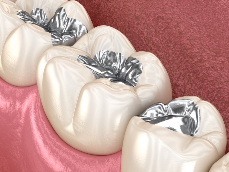 A 3D illustration of metal fillings